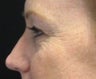 Fraxel CO2 Laser Resurfacing