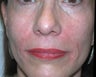 Filler - Nasal Folds