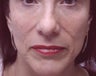Filler - Nasal Folds