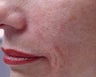 Filler - Nasal Folds