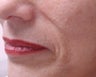 Filler - Nasal Folds