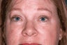 Upper Eyelid Blepharoplasty and Ptosis Repair