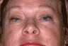 Upper Eyelid Blepharoplasty and Ptosis Repair