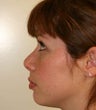Revision Rhinoplasty