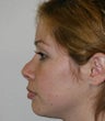 Revision Rhinoplasty