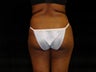 Buttocks Augmentation