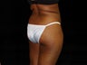 Buttocks Augmentation