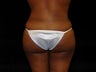 Buttocks Augmentation