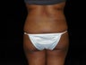 Buttocks Augmentation