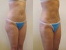 Liposuction