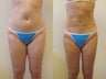 Liposuction