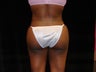 Buttocks Augmentation