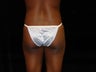 Buttocks Augmentation
