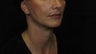 Laser Rhytidectomy (Facelift)