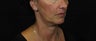 Laser Rhytidectomy (Facelift)