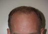 Hair Transplant / 2000 grafts