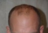 Hair Transplant / 2000 grafts