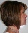 Adult TMJ and orthodontic treatment