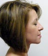 Adult TMJ and orthodontic treatment