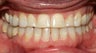 Adult TMJ and orthodontic treatment