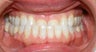 Adult TMJ and orthodontic treatment