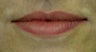 Lip Augmentation