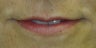 Lip Augmentation