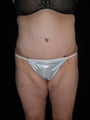 Tummy tuck (abdominoplasty)
