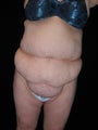 Tummy tuck (abdominoplasty)