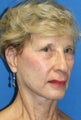 Short Incision face lift and chemical peel