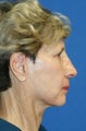 short Incision face lift and chemical peel