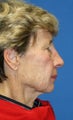 short Incision face lift and chemical peel
