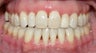 Adult Orthodontic treatment