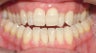 Adult Orthodontic treatment