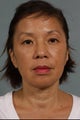 Juvederm LiquidLift