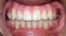 Teen Orthodontic Treatment (case #1BG)