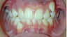 Teen Orthodontic Treatment (case #1BG)