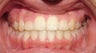 Teen Orthodontic Treatment (case #3MM)