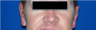 Otoplasty