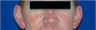 Otoplasty