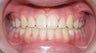 Teen Orthodontic Treatment (case #1AD)