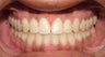 Adult Orthodontic Treatment (case #3KE)