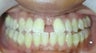 Adult Orthodontic Treatment (case #3KE)