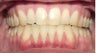 Adult TMJ and orthodontic treatment (case #1JW)