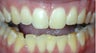 Adult TMJ and orthodontic treatment (case #1JW)