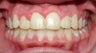 Teen Orthodontic Treatment (case #1RL)