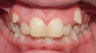 Teen Orthodontic Treatment (case #1RL)
