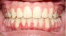 Teen Orthodontic Treatment (case #1DC)