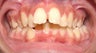 Teen Orthodontic Treatment (case #1DC)