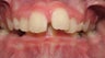 Teen Orthodontic Treatment (case #1JM)